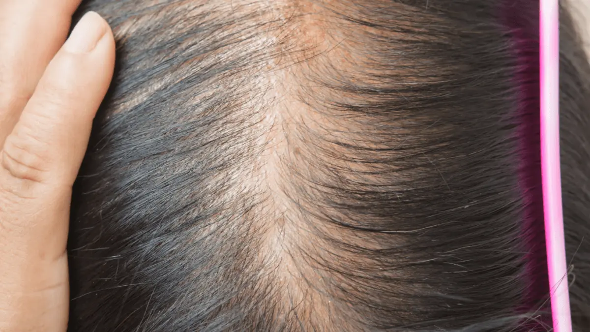 Iron Deficiency Hair loss