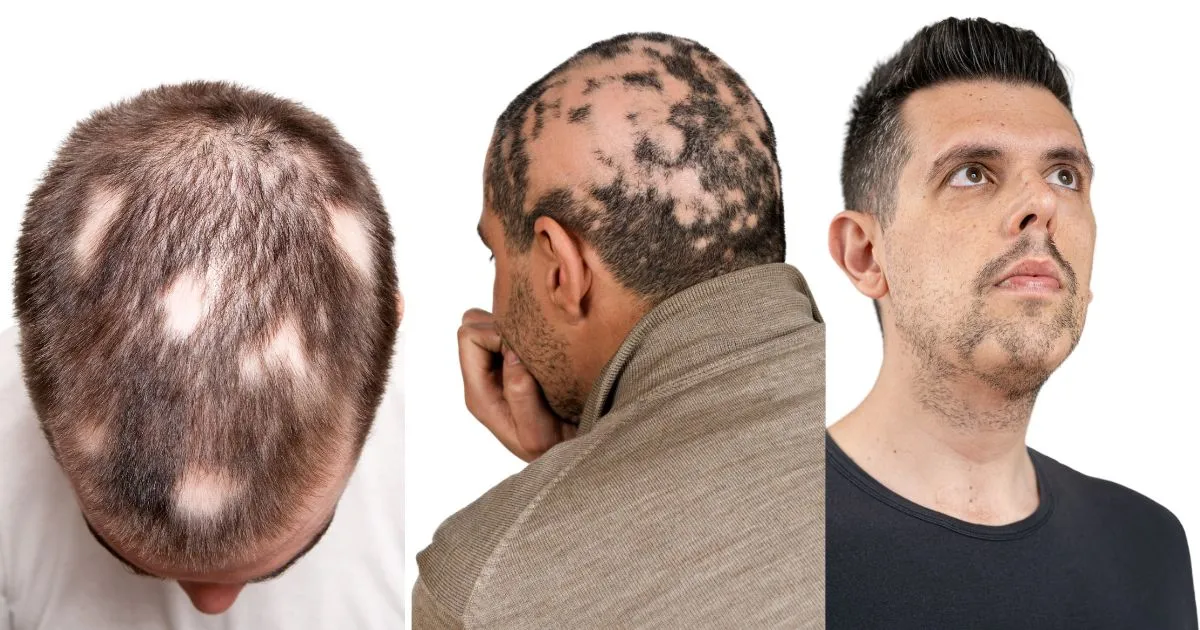 Alopecia Areata: Bald Patches On Head And Beard