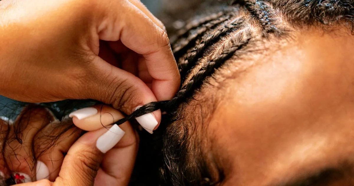 Traction Alopecia: Dreadlocks can cause hair loss around the hairline