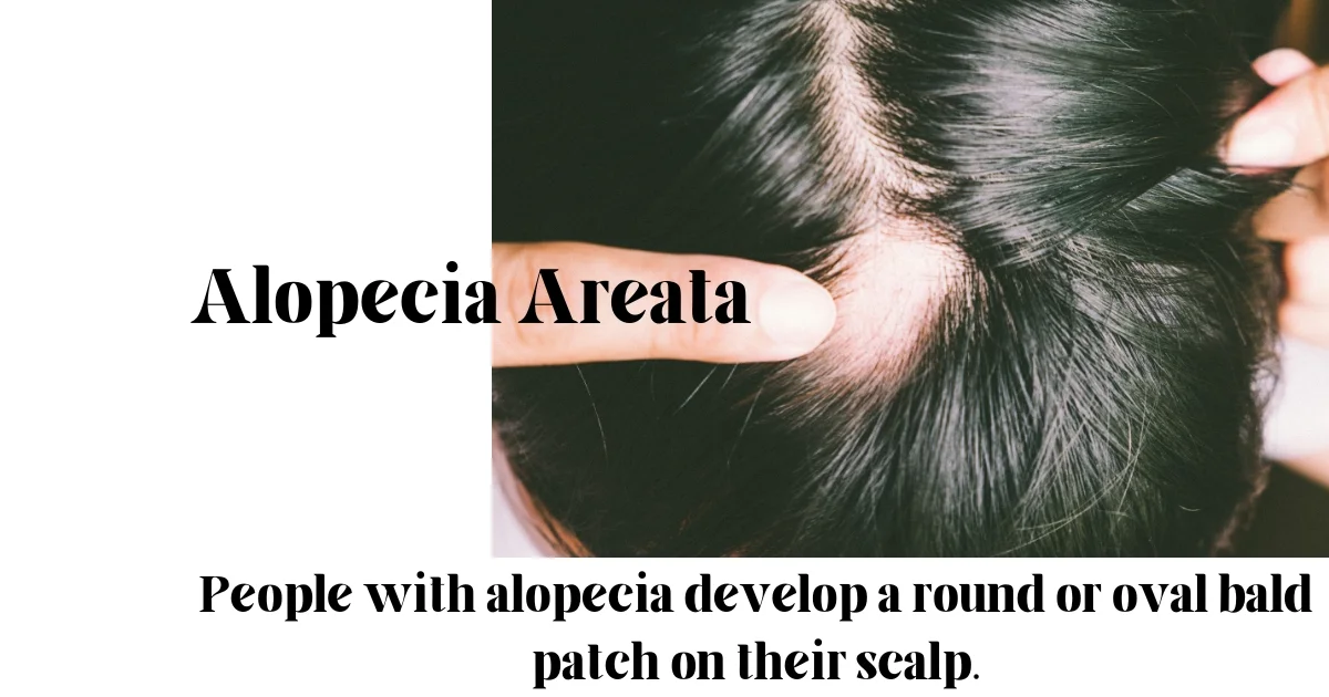 Alopecia Areata - Bald Patch